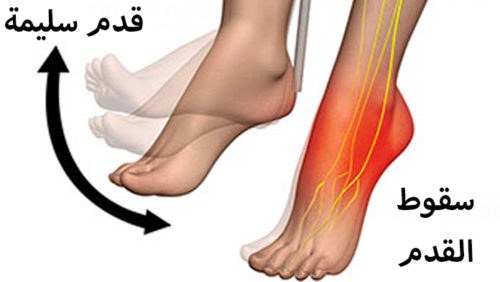 سقوط القدم الأسباب - الأعراض